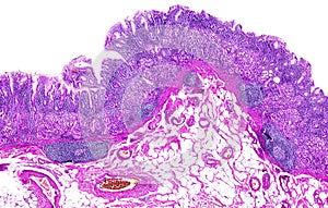 Chronic gastritis of a human photo