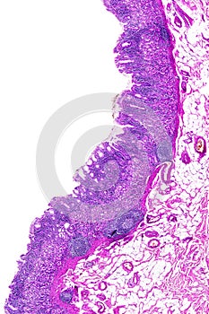 Chronic gastritis of a human photo