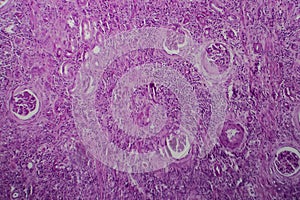 Chronic glomerulonephritis, light micrograph