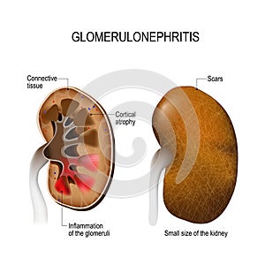 Glomerulonephritis. photo