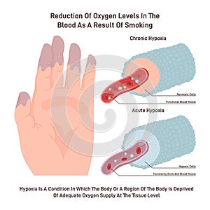 Chronic hypoxia. Dangerous effect of smoking on oxygen supply.