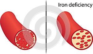 Chronic iron deficiency yellow skin