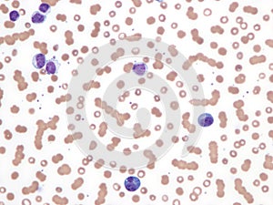 Chronic lymphatic leukemia and lymphoplasmacytic lymphoma in peripheral blood.