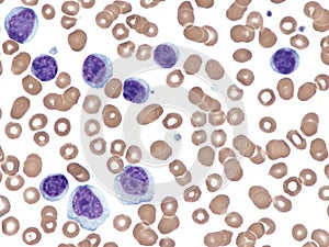Chronic lymphocytic leukemia.