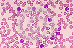 Chronic lymphocytic leukemia or CLL