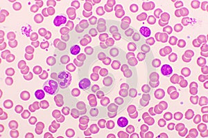 Chronic lymphocytic leukemia or CLL