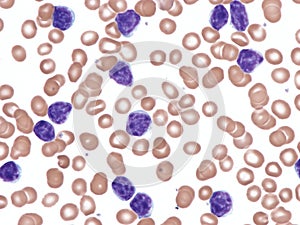 Chronic lymphocytic leukemia in peripheral blood.