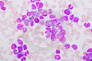 Chronic myeloid leukemia cells or CML photo