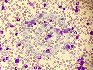 Chronic myeloid leukemia CML. Red blood cell. Blood smear