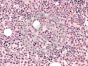 Chronic myeloid leukemia, bone marrow.