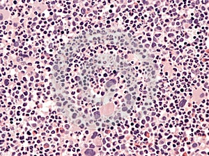 Chronic myeloid leukemia, bone marrow.