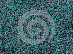 Chronic myeloid leukemia, bone marrow.