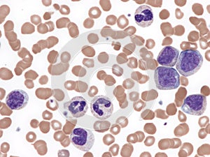 Chronic myeloid leukemia, peripheral blood