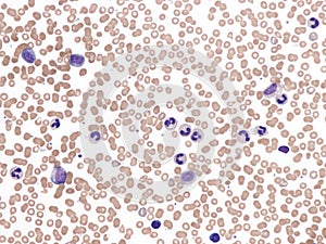 Chronic myeloid leukemia, peripheral blood