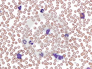 Chronic myelomonocytic leukemia.