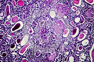 Chronic nephritis, light micrograph