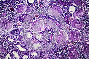 Chronic nephritis, light micrograph