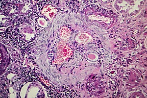 Chronic nephritis, light micrograph photo