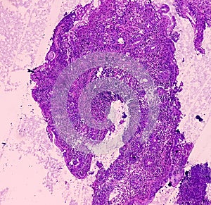 Chronic nonspecific ileitis. Section show ileal mucosa in lamina propria. IBD.