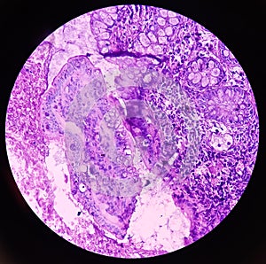 Chronic nonspecific ileitis with ulcer. IBD. photo