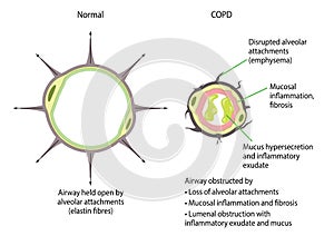 Chronic obstructive pulmonary disease