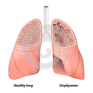 Chronic obstructive pulmonary disease