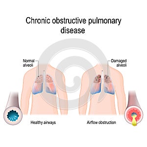 Chronic obstructive pulmonary disease COPD photo