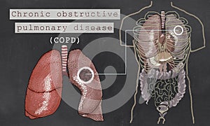 Chronic Obstructive Pulmonary Disease with Lungs
