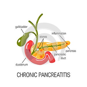 Chronic pancreatitis concept. Vector illustration