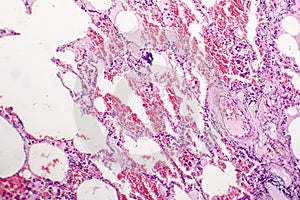 Chronic pulmonary congestion and edema