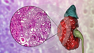 Chronic pyelonephritis, illustration and light micrograph photo