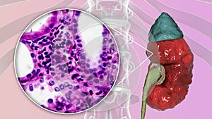 Chronic pyelonephritis, illustration and light micrograph photo