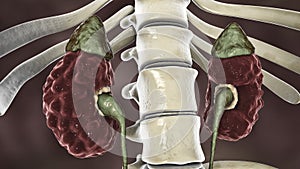 Chronic pyelonephritis, illustration