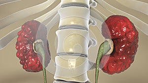 Chronic pyelonephritis, illustration