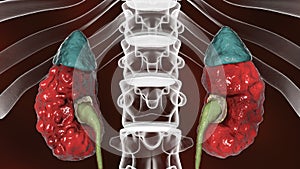 Chronic pyelonephritis, illustration