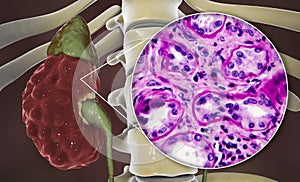 Chronic pyelonephritis, illustration and light micrograph