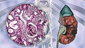 Chronic pyelonephritis, illustration and light micrograph