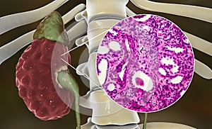 Chronic pyelonephritis, illustration and light micrograph photo