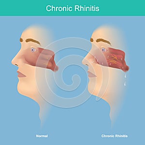 Chronic Rhinitis. This illustration medical use for explain comparison chronic rhinitis symptoms have mucus in the nose