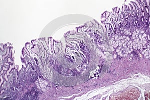 Chronic superficial gastritis, light micrograph