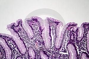 Chronic superficial gastritis, light micrograph