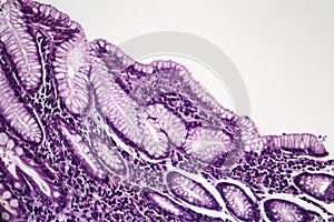 Chronic superficial gastritis, light micrograph