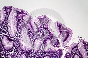 Chronic superficial gastritis, light micrograph photo
