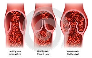 Chronic Venous Insufficiency or venous reflux.Venous Disease Varicose vein Faulty valve. Healthy vein photo