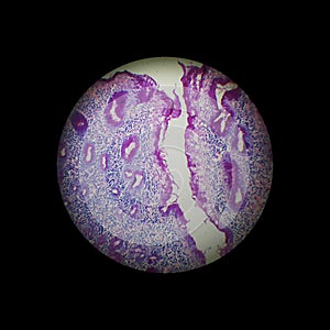 Chronical gastritis