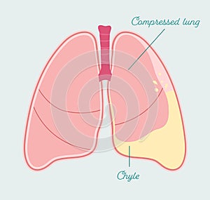 Chylothorax in human lung. Accumulation of lymph in pleural space - vector anatomical scheme