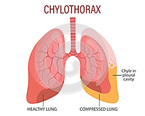 Chylothorax, lung diseases. Healthcare. Medical infographic banner, illustration