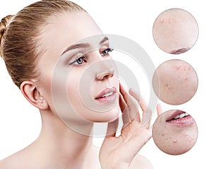 Circles shows problem skin of young woman.