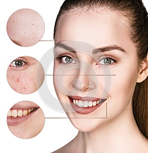 Circles shows problem skin of young woman.