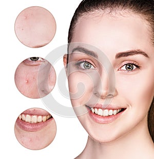 Circles shows problem skin of young woman.